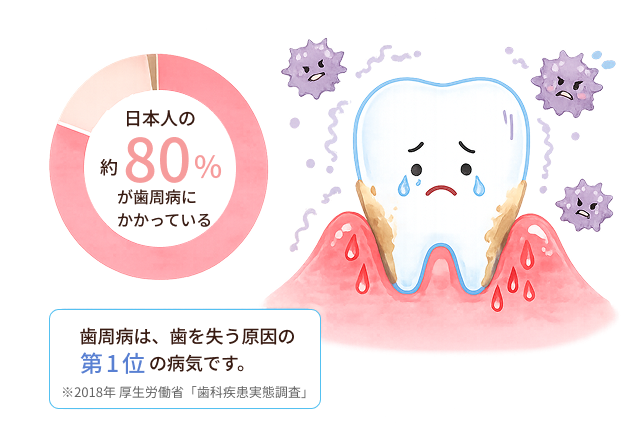 日本人の約80％が歯周病にかかっていることを示す図と、歯周病の歯のイラスト